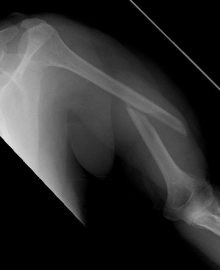 Oberarmschaftbruch1 Oberarmschaftbruch1